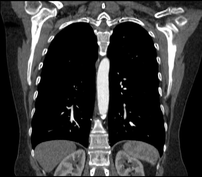 File:Adenocarcinoma of the lung (Radiopaedia 44205-47803 Coronal C+ portal venous phase 66).jpg