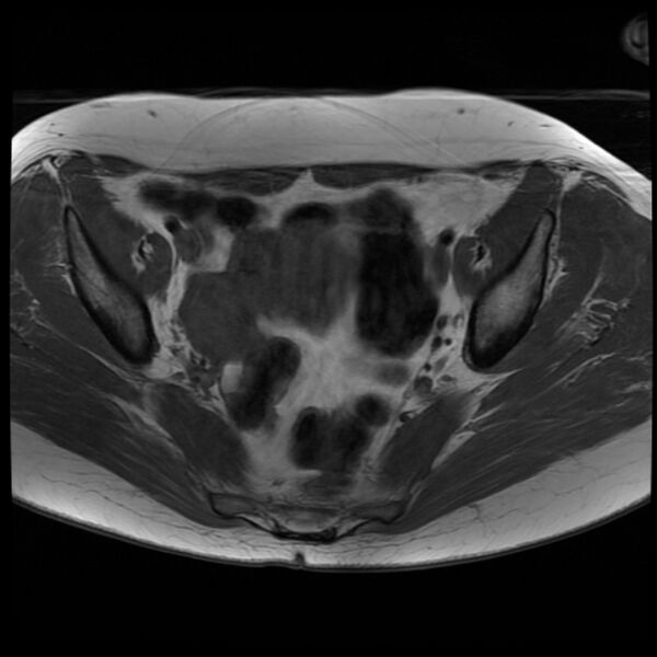 File:Adenoma malignum of the cervix (Radiopaedia 24460-24765 T1 8).jpg