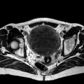 Adenomyoma of the uterus (huge) (Radiopaedia 9870-10438 Axial T2 16).jpg