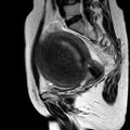 Adenomyoma of the uterus (huge) (Radiopaedia 9870-10438 Sagittal T2 6).jpg