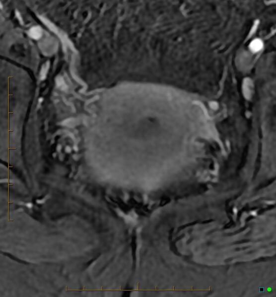 File:Adenomyosis uterus with hematometra (Radiopaedia 45779-50011 Axial T1 C+ fat sat 44).jpg