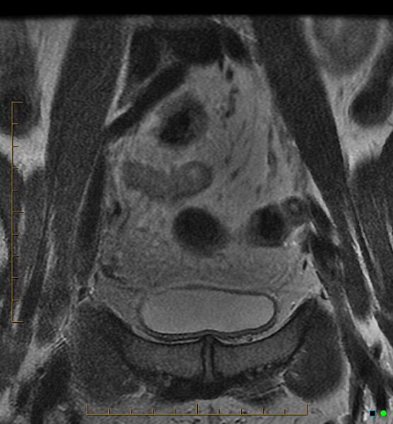 File:Adenomyosis uterus with hematometra (Radiopaedia 45779-50011 Coronal T2 1).jpg