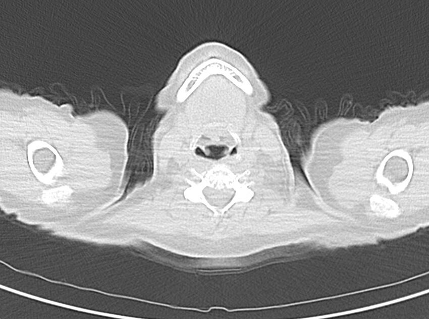 Adenosquamous lung carcinoma (Radiopaedia 22035-22030 lung window 3).jpg