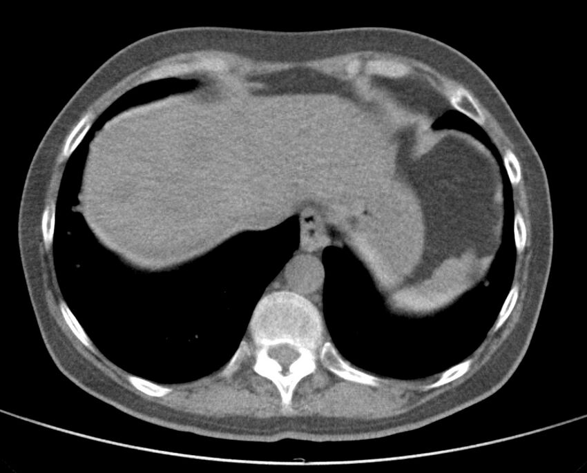 Adenosquamous lung carcinoma (Radiopaedia 22035-22030 non-contrast 50).jpg