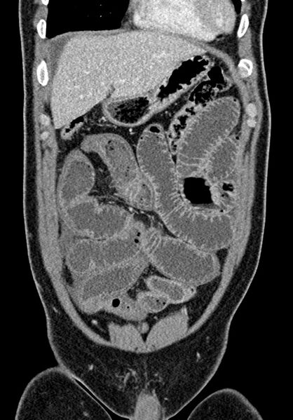 File:Adhesional small bowel obstruction (Radiopaedia 58900-66131 Coronal C+ portal venous phase 89).jpg
