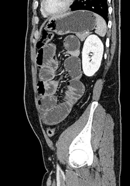 File:Adhesional small bowel obstruction (Radiopaedia 58900-66131 Sagittal C+ portal venous phase 187).jpg