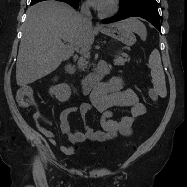 File:Adrenal myelolipoma (Radiopaedia 8216-9068 non-contrast 2).jpg