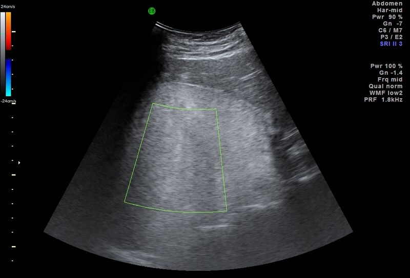 File:Adrenal myelolipoma - bilateral (Radiopaedia 74805-85811 Abdominal ultrasound 3).jpg