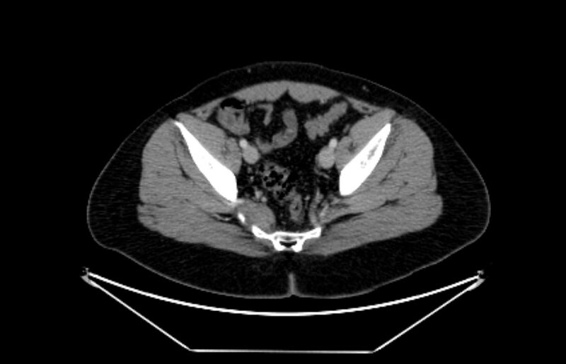 File:Adrenocortical carcinoma (Radiopaedia 80134-93438 Axial C+ portal venous phase 112).jpg