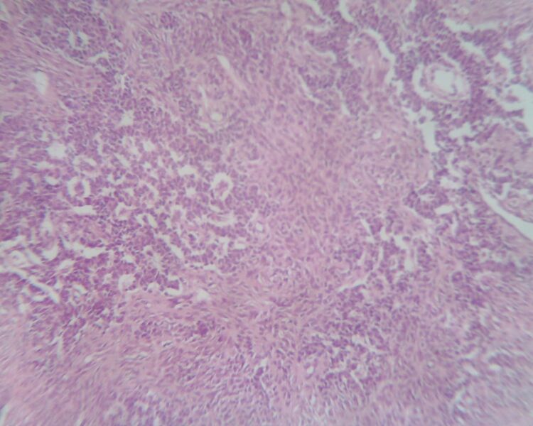 File:Adult granulosa cell tumor of the ovary (Radiopaedia 64991-74394 F 1).jpg