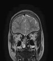 Aicardi syndrome (Radiopaedia 66029-75205 Coronal T2 4).jpg