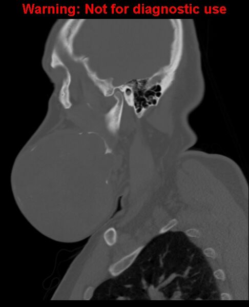 File:Ameloblastoma (Radiopaedia 33126-34164 Sagittal bone window 22).jpg