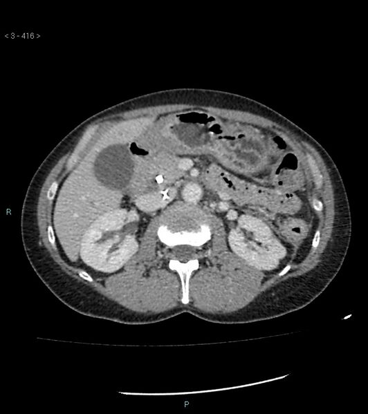 File:Ampulla of Vater metastasis (Radiopaedia 27820-28069 A 54).jpg