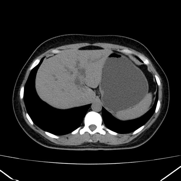 File:Ampullary tumor (Radiopaedia 22787-22816 Axial non-contrast 10).jpg