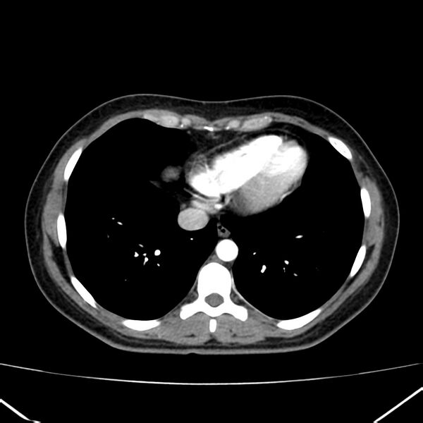File:Ampullary tumor (Radiopaedia 22787-22816 B 3).jpg