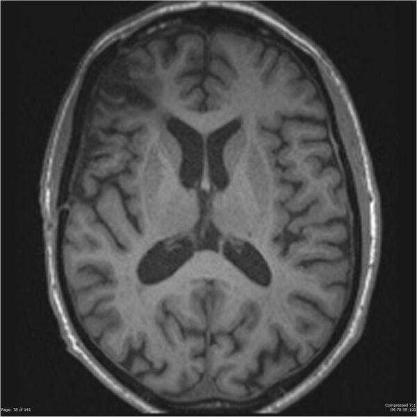 File:Anaplastic meningioma with recurrence (Radiopaedia 34452-35788 Axial T1 76).jpg