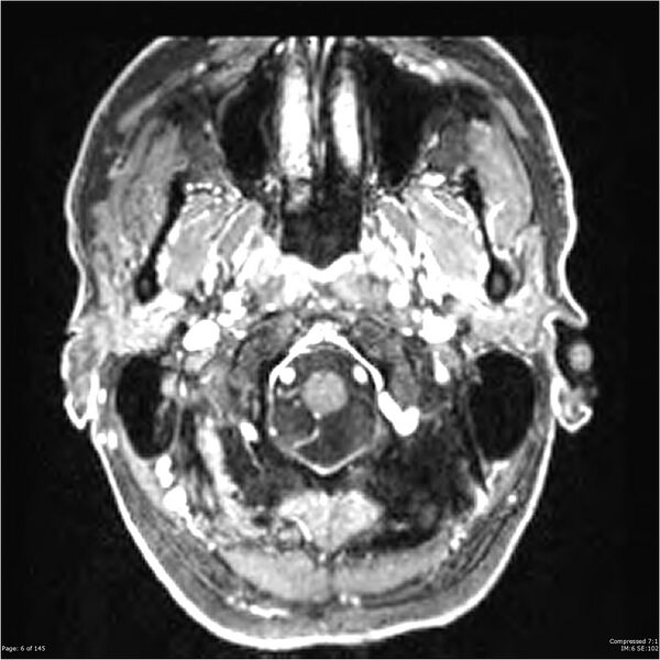 File:Anaplastic meningioma with recurrence (Radiopaedia 34452-35788 Axial T1 C+ 6).jpg