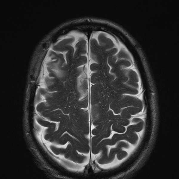 File:Anaplastic meningioma with recurrence (Radiopaedia 34452-35788 Axial T2 22).png