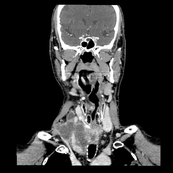 File:Anaplastic thyroid carcinoma (Radiopaedia 79087-92034 A 56).jpg
