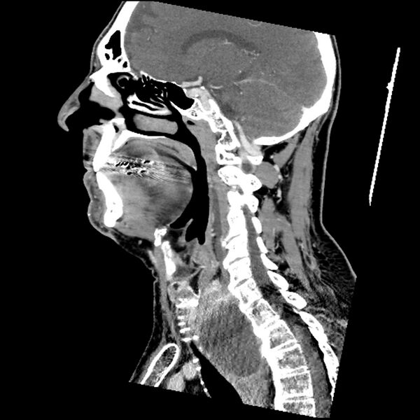 File:Anaplastic thyroid carcinoma (Radiopaedia 79087-92034 C 51).jpg
