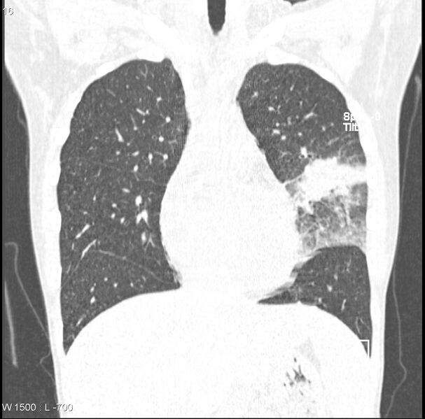 File:Angioinvasive aspergillosis (Radiopaedia 8651-9466 Coronal lung window 2).jpg