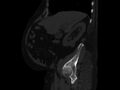 Ankylosing spondylitis (Radiopaedia 44609-48357 Sagittal bone window 26).jpg