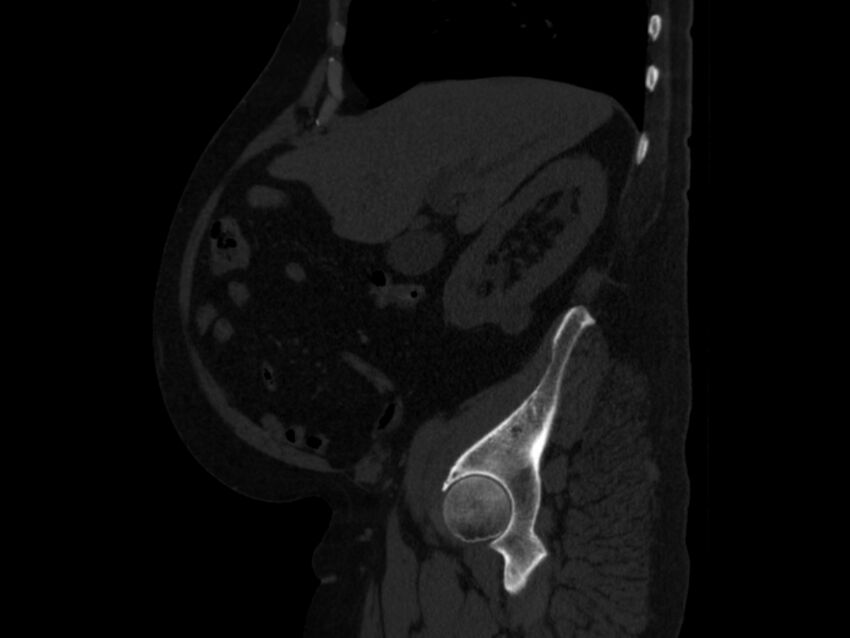 Ankylosing spondylitis (Radiopaedia 44609-48357 Sagittal bone window 26).jpg