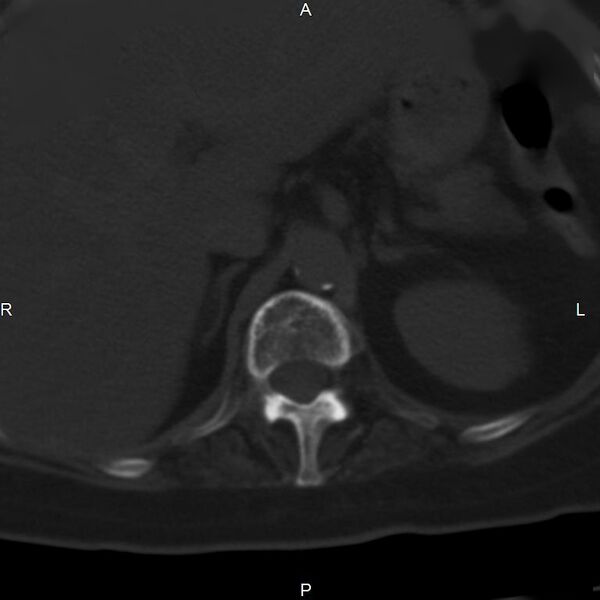 File:Ankylosing spondylitis (Radiopaedia 8748-9556 Axial bone window 17).jpg