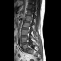 Ankylosing spondylitis with zygapophyseal arthritis (Radiopaedia 38433-40516 Sagittal T1 3).jpg