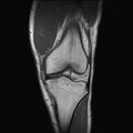 Anterior cruciate ligament full thickness tear (Radiopaedia 66268-75467 Coronal T1 7).jpg