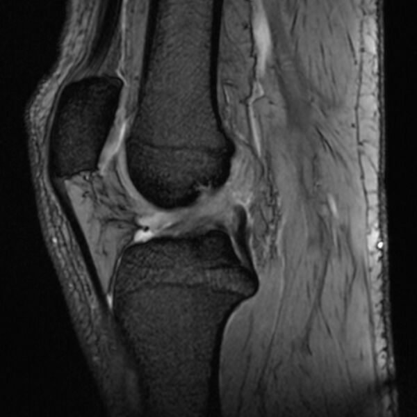 File:Anterior cruciate ligament tear - ramp lesion (Radiopaedia 71883-82322 Sagittal T2 fat sat 13).jpg