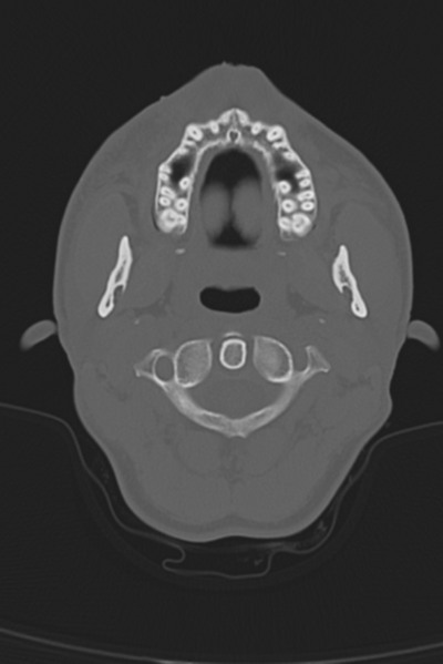 File:Anterior nasal spine fracture (Radiopaedia 46138-50494 Axial bone window 58).png