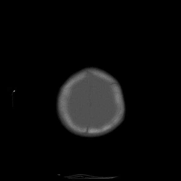File:Anterior plagiocephaly (Radiopaedia 71836-82273 Axial bone window 19).jpg