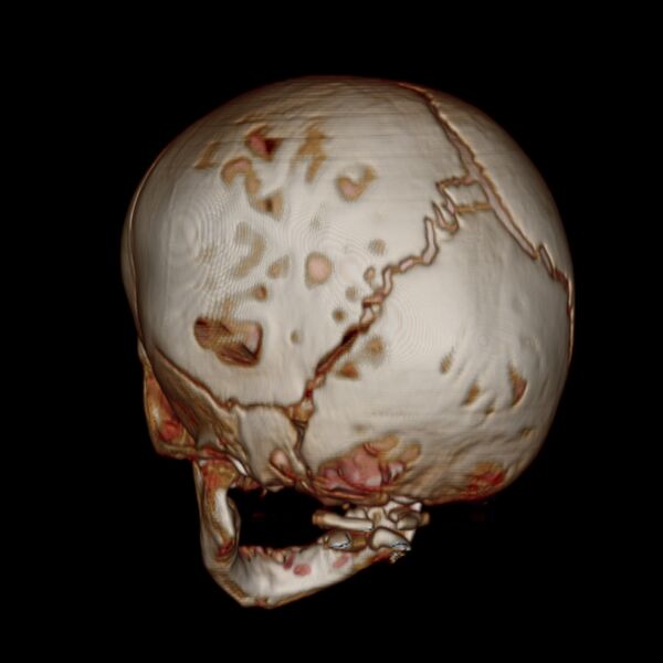 File:Anterior plagiocephaly (Radiopaedia 71836-82273 E 5).jpg