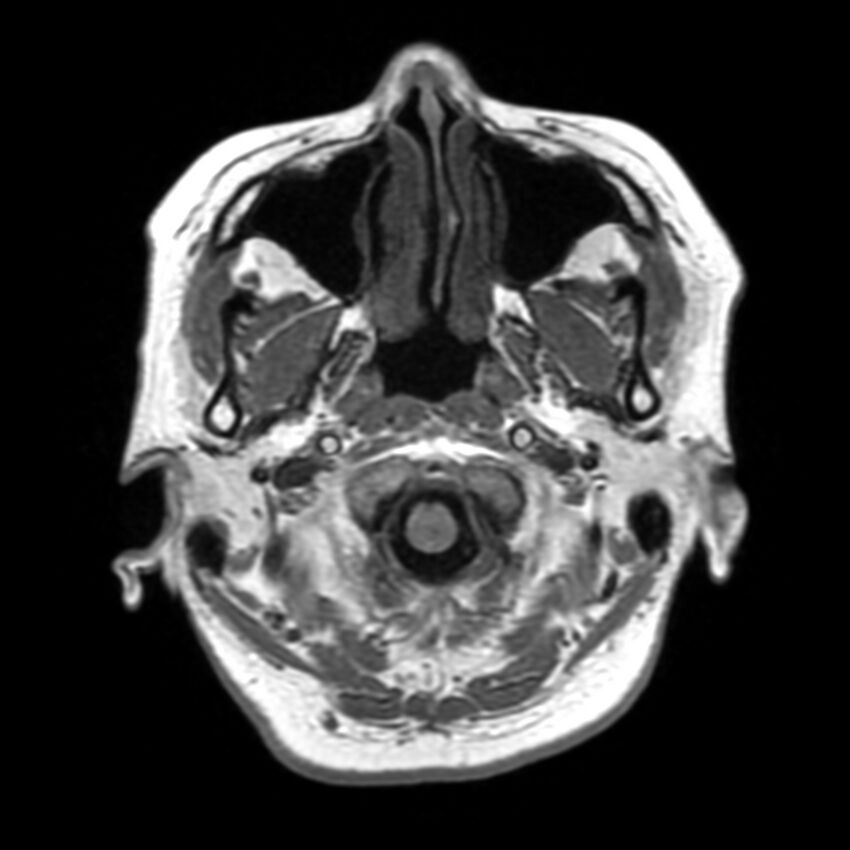 Anti-MOG encephalomyelitis (Radiopaedia 73831-84646 Axial T1 6).jpg