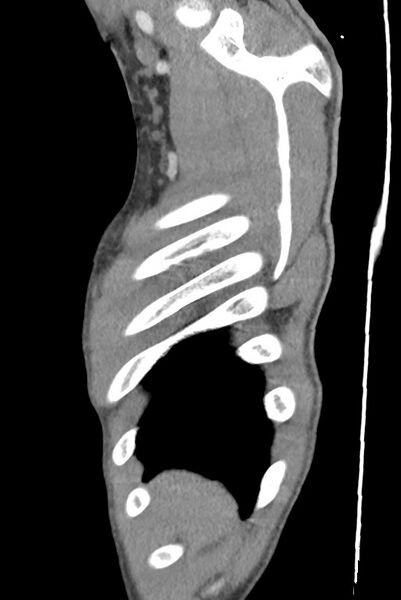 File:Aortic coarctation with aneurysm (Radiopaedia 74818-85828 B 19).jpg