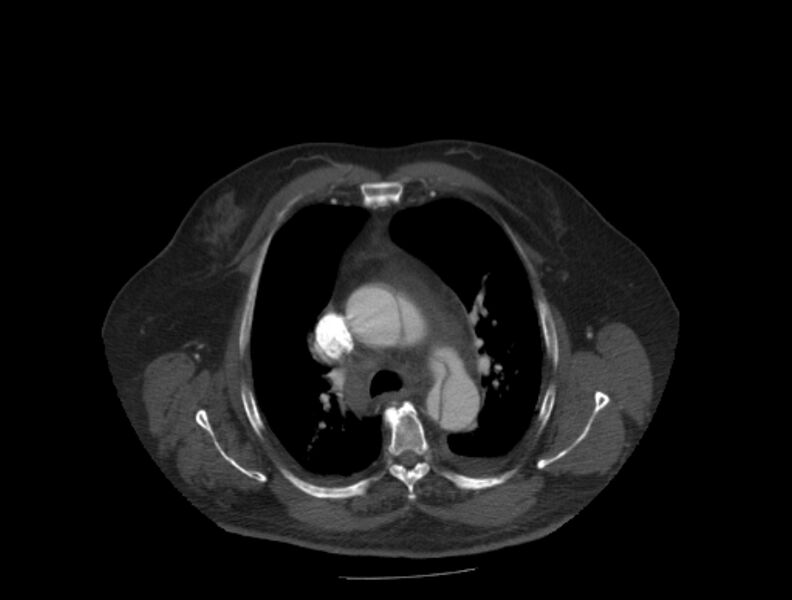File:Aortic dissection (Radiopaedia 28802-29105 A 11).jpg