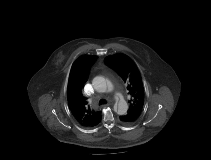 Aortic dissection (Radiopaedia 28802-29105 A 11).jpg
