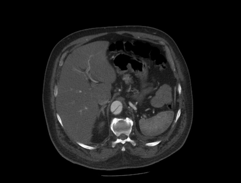 File:Aortic dissection (Radiopaedia 28802-29105 A 42).jpg