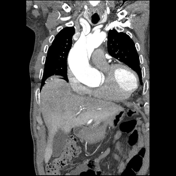 File:Aortic dissection - DeBakey Type I-Stanford A (Radiopaedia 79863-93115 B 12).jpg