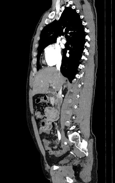 File:Aortic dissection - Stanford type A (Radiopaedia 83418-98500 B 13).jpg