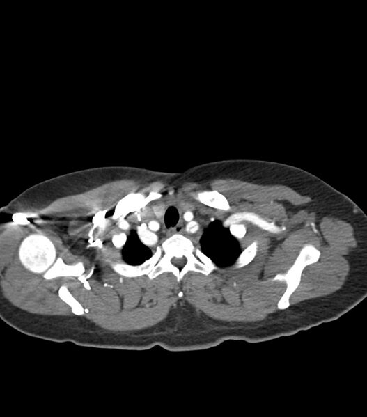 File:Aortic dissection with renal ischemia (Radiopaedia 76573-88338 A 4).jpg