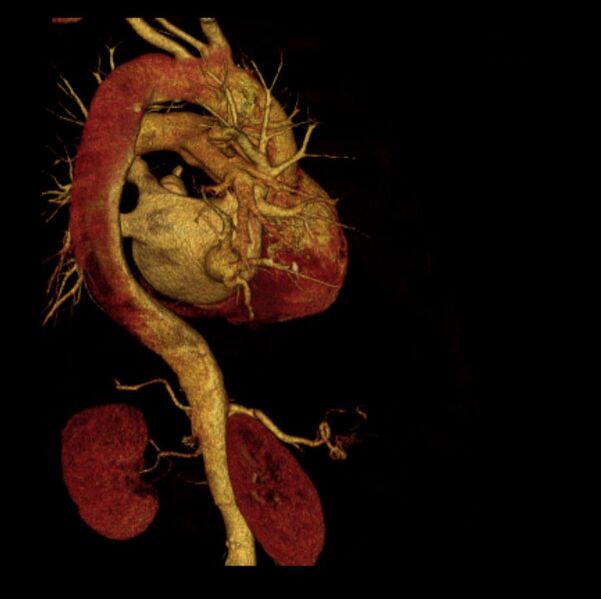File:Aortic dissection with rupture into pericardium (Radiopaedia 12384-12647 D 15).jpg
