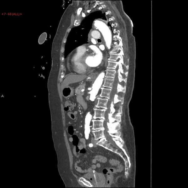 File:Aortic intramural hematoma (Radiopaedia 27746-28001 C 37).jpg