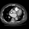 Aorto-coronary bypass graft aneurysms (Radiopaedia 40562-43157 A 69).png