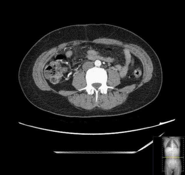 File:Appendicitis (CT angiogram) (Radiopaedia 154713-127660 Axial 63).jpg
