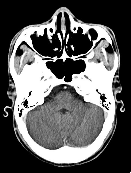 File:Arrow injury to the face (Radiopaedia 73267-84011 Axial C+ delayed 40).jpg