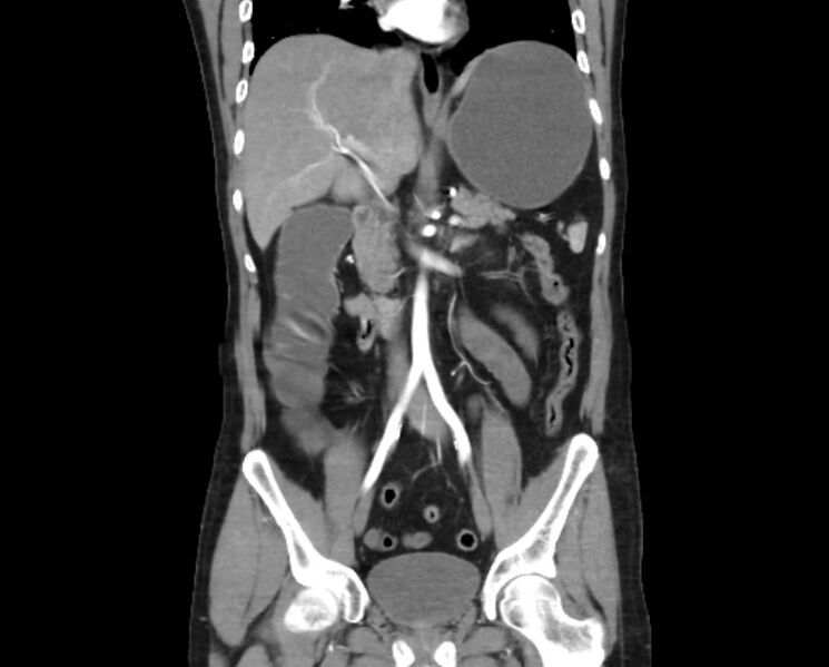 File:Arterial occlusive mesenteric ischemia (Radiopaedia 84641-100060 B 29).jpg