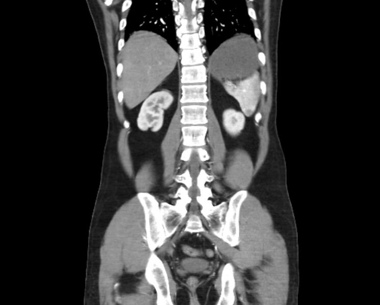 File:Arterial occlusive mesenteric ischemia (Radiopaedia 84641-100060 B 42).jpg