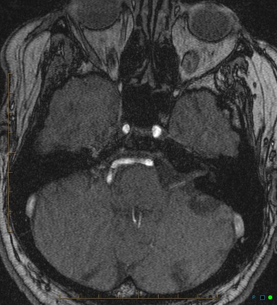 File:Artifactual basilar artery stenosis due to metallic stent (Radiopaedia 31206-31922 Axial MRA 2).jpg